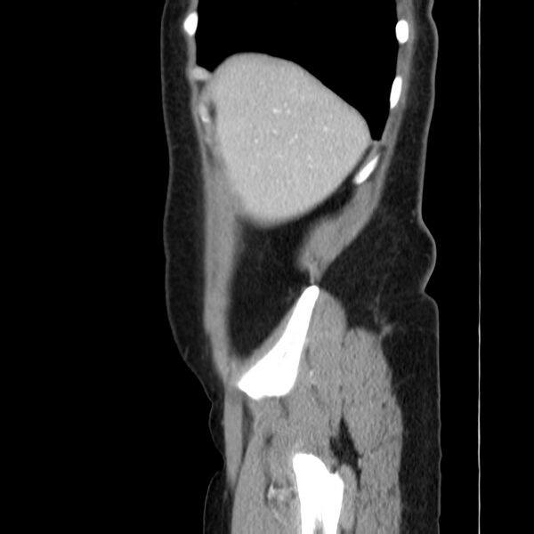 File:Ampullary tumor (Radiopaedia 22787-22816 D 9).jpg