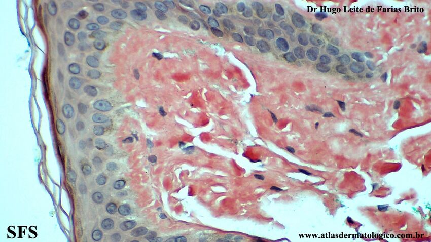 Amyloidosis-Nodular Amyloidosis (Dermatology Atlas 23).jpg