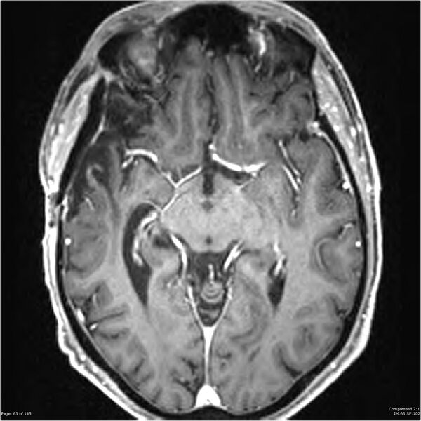 File:Anaplastic meningioma with recurrence (Radiopaedia 34452-35788 Axial T1 C+ 63).jpg