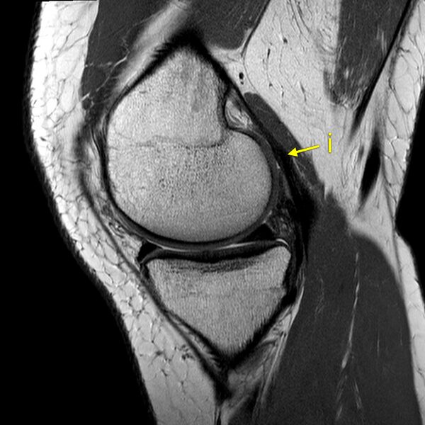 File:Anatomy Quiz (MRI knee) (Radiopaedia 43478-46865 A 7).jpeg
