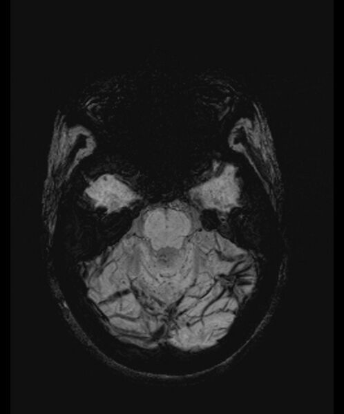 File:Angiomatous meningioma (Radiopaedia 79459-92579 E 18).jpg