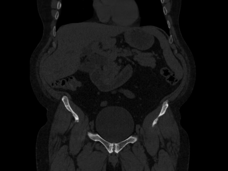 File:Ankylosing spondylitis (Radiopaedia 44609-48357 Coronal bone window 6).jpg