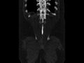 Ankylosing spondylitis (Radiopaedia 44609-48357 Coronal bone window 95).jpg