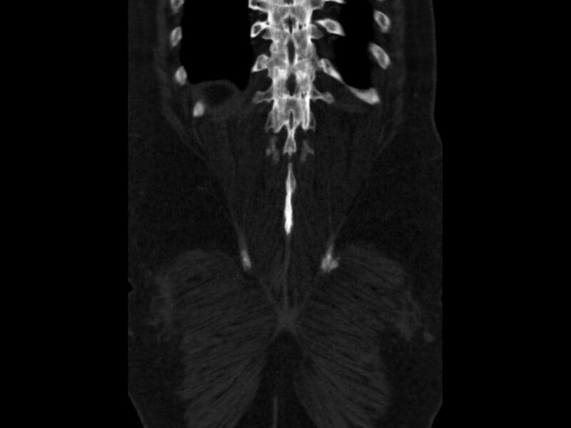File:Ankylosing spondylitis (Radiopaedia 44609-48357 Coronal bone window 95).jpg