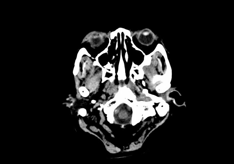 File:Anomalous intracranial venous drainage (Radiopaedia 28161-28418 Axial non-contrast 2).jpg