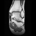 Anterior calcaneal process fracture (Radiopaedia 74654-85611 Coronal T1 12).jpg