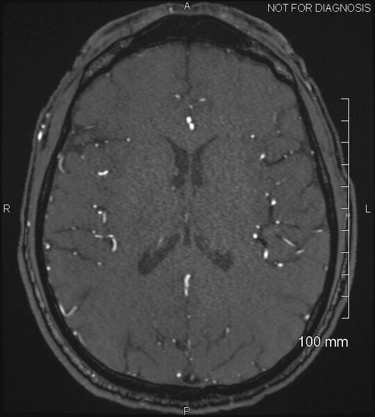 File:Anterior cerebral artery aneurysm (Radiopaedia 80683-94127 Axial MRA 144).jpg