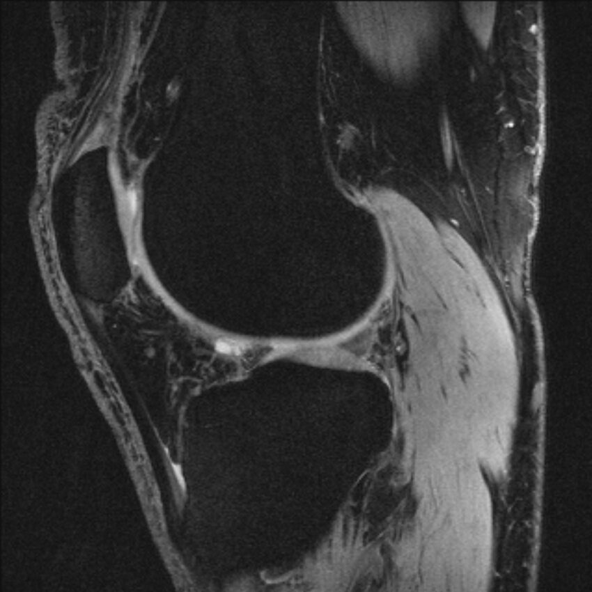 Anterior cruciate ligament mucoid degeneration (Radiopaedia 68400-77933 Sagittal 21).jpg