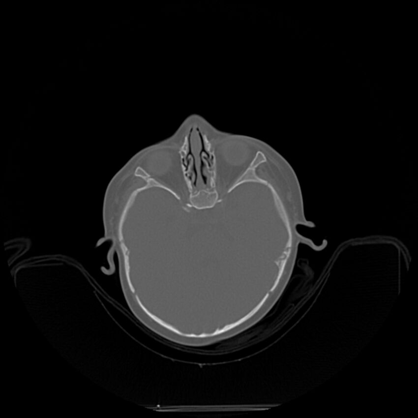 Anterior plagiocephaly (Radiopaedia 71836-82273 C 1).jpg