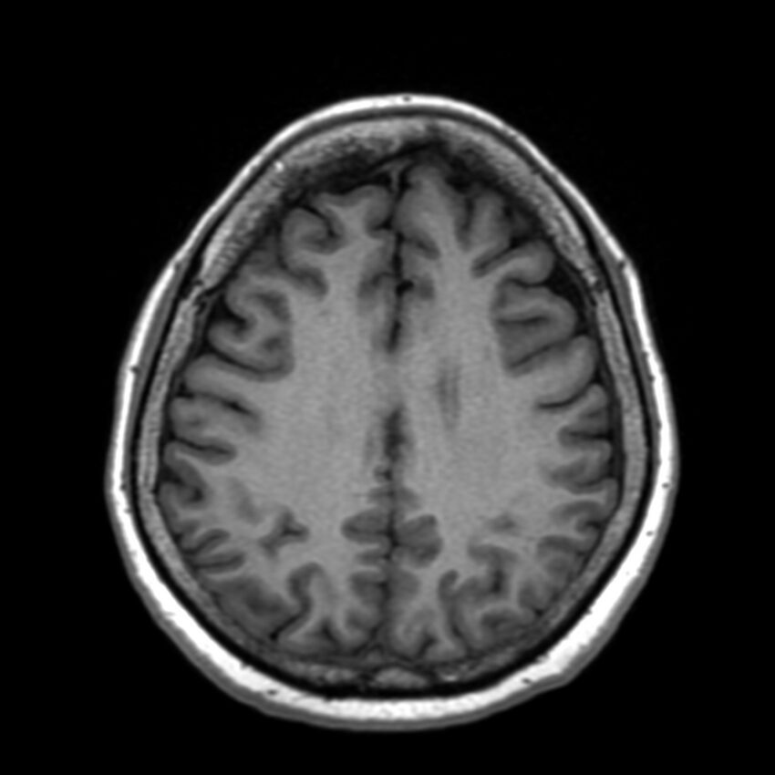 Anti-MOG encephalomyelitis (Radiopaedia 73831-84646 Axial T1 35).jpg