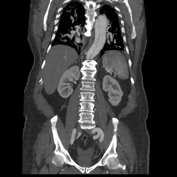 File:Aortic dissection (Radiopaedia 28802-29105 B 26).jpg