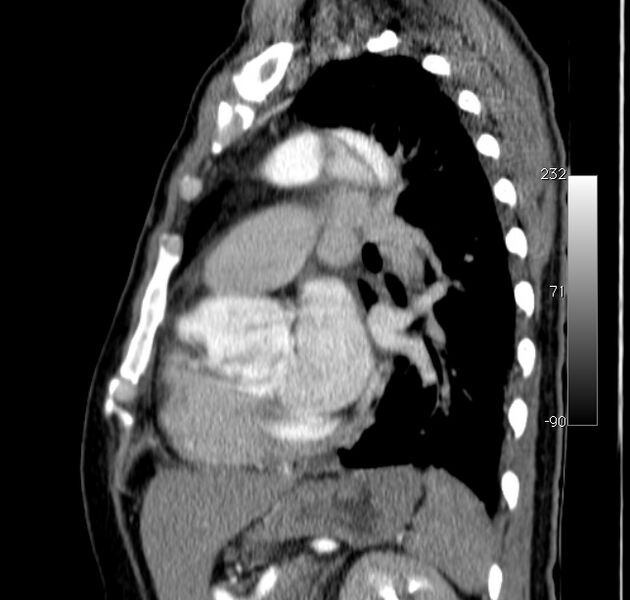 File:Aortic dissection - Stanford type A (Radiopaedia 29247-29659 C 18).jpg