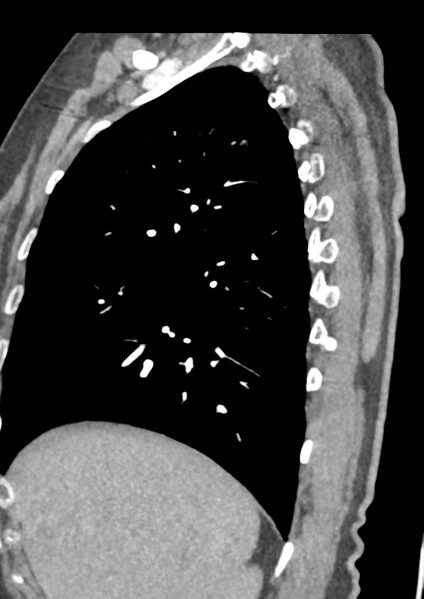 File:Aortic dissection - Stanford type B (Radiopaedia 50171-55512 C 55).png