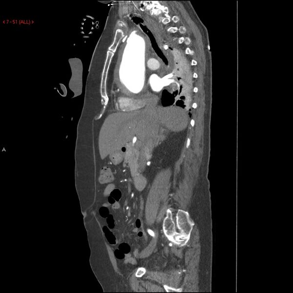 File:Aortic intramural hematoma (Radiopaedia 27746-28001 C 20).jpg