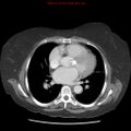 Aortic valve stenosis (Radiopaedia 14480-14423 C 6).jpg