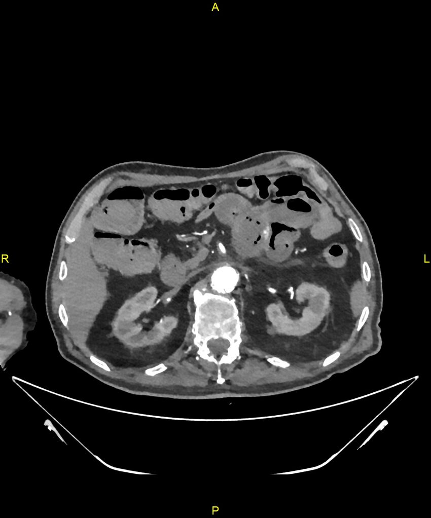 Aortoenteric fistula (Radiopaedia 84308-99603 B 104).jpg