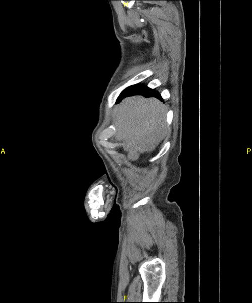 File:Aortoenteric fistula (Radiopaedia 84308-99603 C 31).jpg