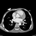 Aortopulmonary window, interrupted aortic arch and large PDA giving the descending aorta (Radiopaedia 35573-37074 B 47).jpg