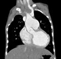 Aortopulmonary window, interrupted aortic arch and large PDA giving the descending aorta (Radiopaedia 35573-37074 D 22).jpg