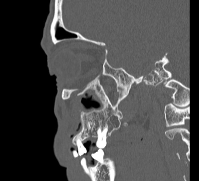 File:Aplastic maxillary sinuses (Radiopaedia 60030-67561 Sagittal bone window 6).jpg