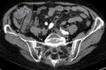 Appendicitis (Radiopaedia 23594).jpg