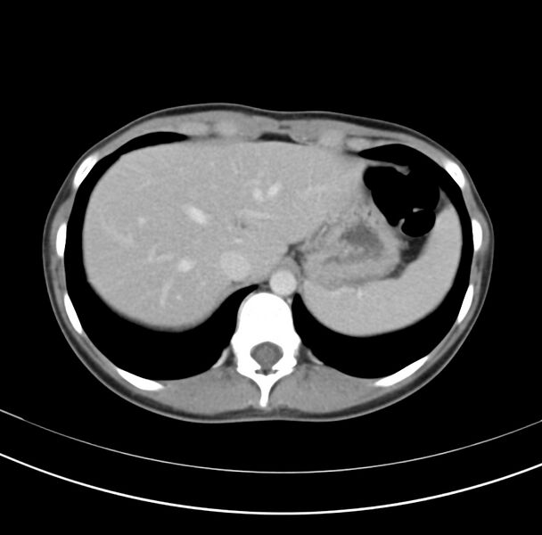 File:Appendicitis and incidental bicornuate uterus (Radiopaedia 22833-22853 B 7).jpg