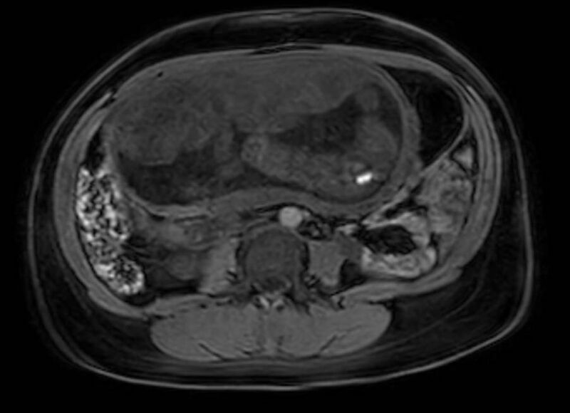 File:Appendicitis in gravida (MRI) (Radiopaedia 89433-106395 Axial DIXON 72).jpg