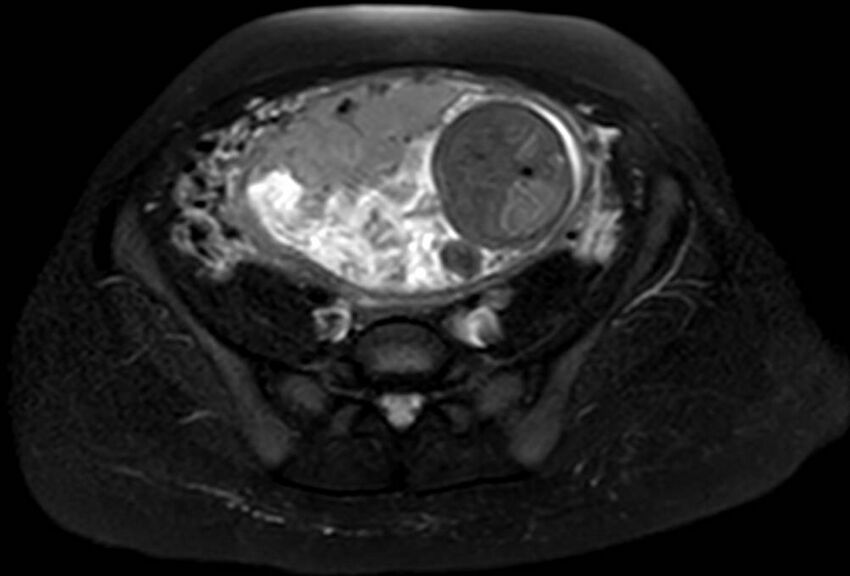 Appendicitis in gravida (MRI) (Radiopaedia 89433-106395 Axial T2 SPAIR 54).jpg
