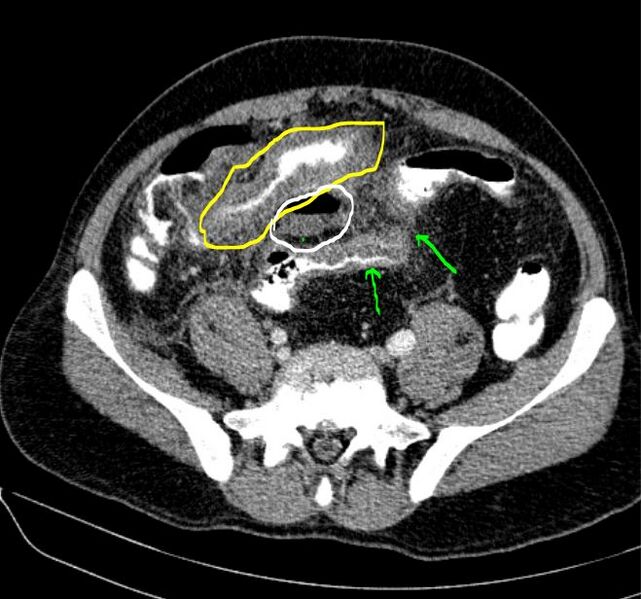 File:Appendicular phlegmon (Radiopaedia 80777-94269 axial CT scan 1).JPG