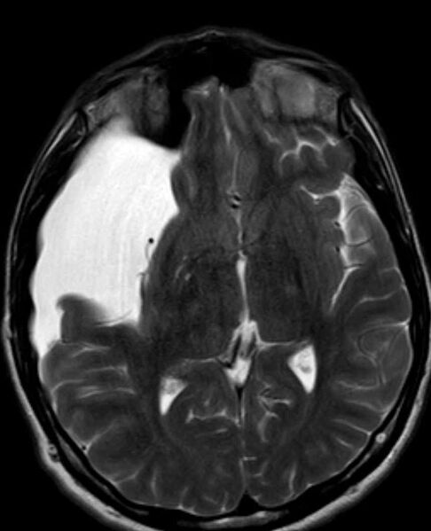 File:Arachnoid cyst- extremely large (Radiopaedia 68741-78451 Axial T2 13).jpg