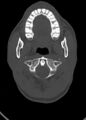 Arrow injury to the head (Radiopaedia 75266-86388 Axial bone window 35).jpg