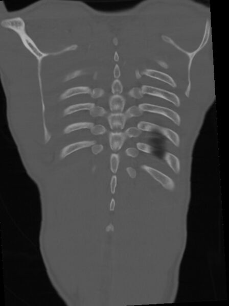 File:Arrow injury to the neck (Radiopaedia 75225-86323 Coronal bone window 104).jpg