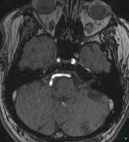 File:Artifactual basilar artery stenosis due to metallic stent (Radiopaedia 31206-31922 Axial MRA 1).jpg