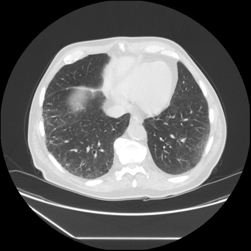 Asbestosis complicated by lung cancer (Radiopaedia 45834-50116 Axial lung window 52).jpg