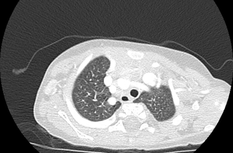 File:Asplenia syndrome (Radiopaedia 73083-83792 Axial lung window 10).jpg