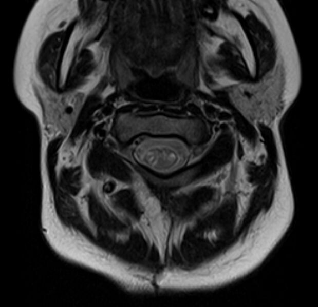 File:Astrocytoma - spinal cord (Radiopaedia 69769-79758 Axial T2 6).jpg