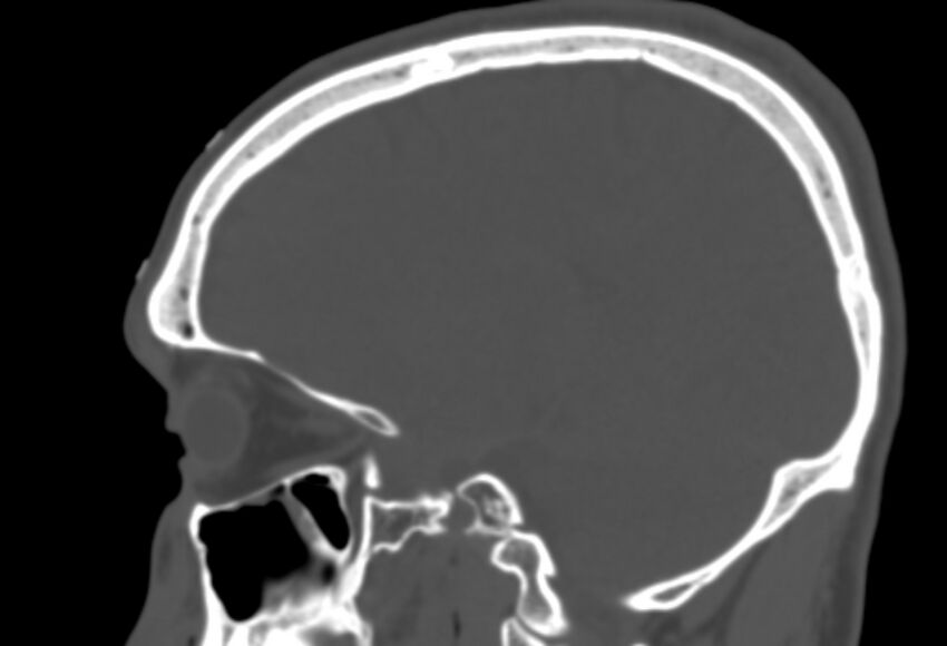 Asymptomatic occipital spur (Radiopaedia 87753-104201 Sagittal bone window 194).jpg