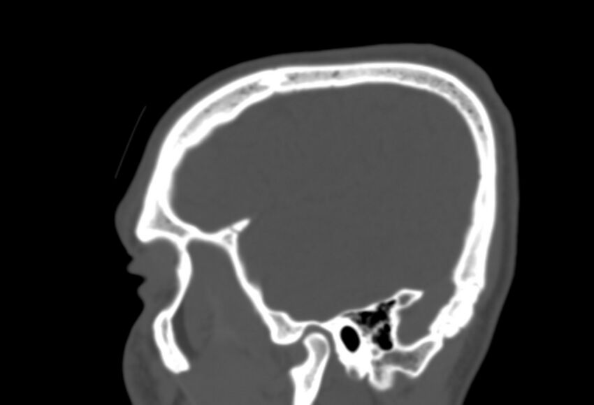 Asymptomatic occipital spur (Radiopaedia 87753-104201 Sagittal bone window 43).jpg