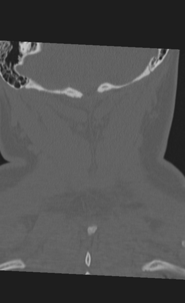 File:Atlanto-occipital dissociation (Radiopaedia 33848-35013 Coronal bone window 49).png