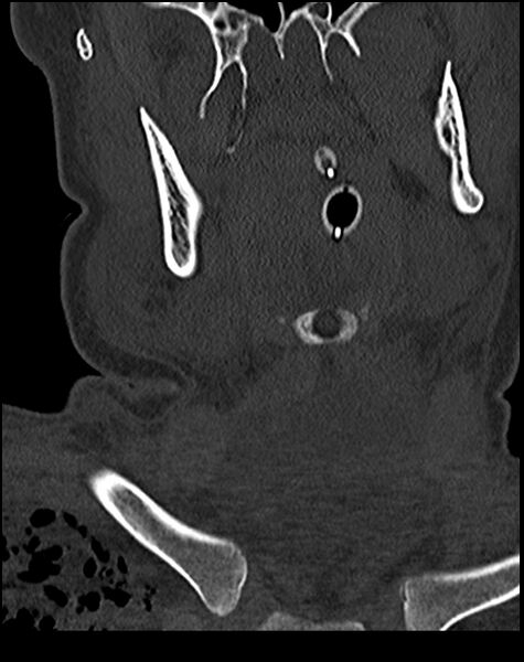 File:Atlanto-occipital dissociation - Traynelis type 1 (Radiopaedia 87570-103948 Coronal bone window 8).jpg