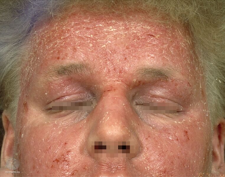 File:Atopic dermatitis (DermNet NZ atopic21).jpg