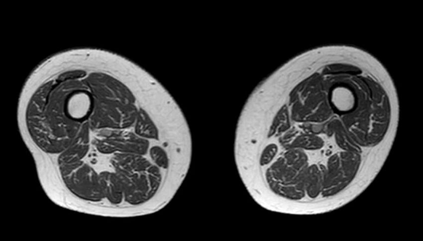Atypical lipomatous tumor - thigh (Radiopaedia 68975-78734 Axial T1 39).jpg