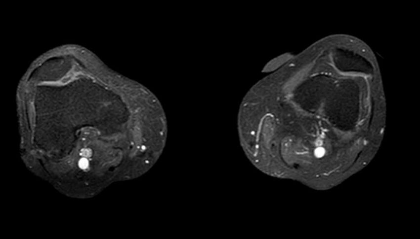 Atypical lipomatous tumor - thigh (Radiopaedia 68975-78734 Axial T1 C+ fat sat 13).jpg