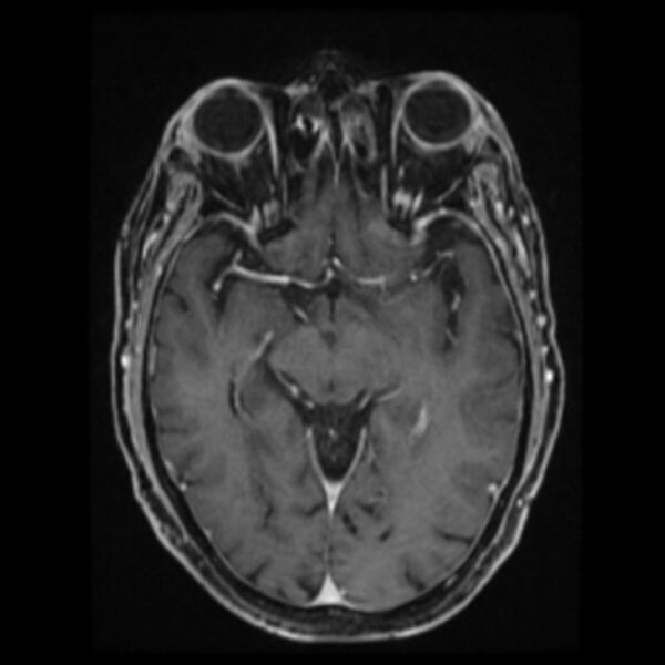 File:Atypical meningioma (Radiopaedia 45535-49629 Axial T1 C+ 34).jpg
