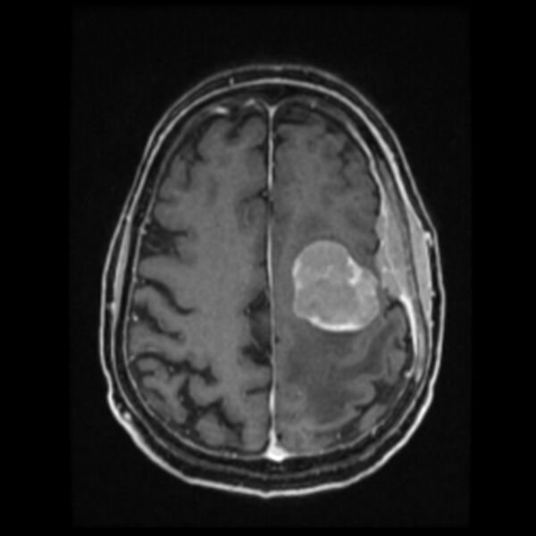 File:Atypical meningioma (Radiopaedia 45535-49629 Axial T1 C+ 50).jpg