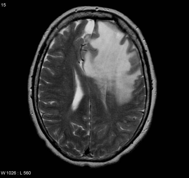 File:Atypical meningioma (WHO grade II) (Radiopaedia 5273-7016 Axial T2 8).jpg
