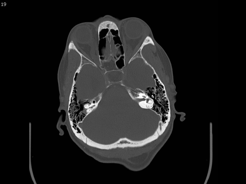 Atypical meningioma - intraosseous (Radiopaedia 64915-73867 Axial C+ bone window 19).jpg