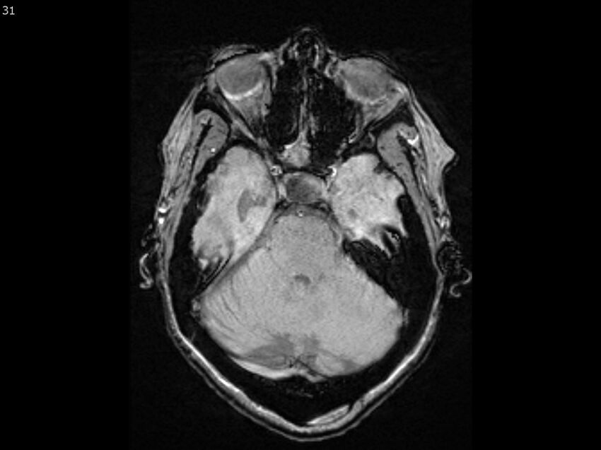 Atypical meningioma - intraosseous (Radiopaedia 64915-74572 Axial SWI 31).jpg