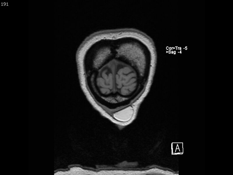 File:Atypical meningioma - intraosseous (Radiopaedia 64915-74572 Coronal T1 191).jpg
