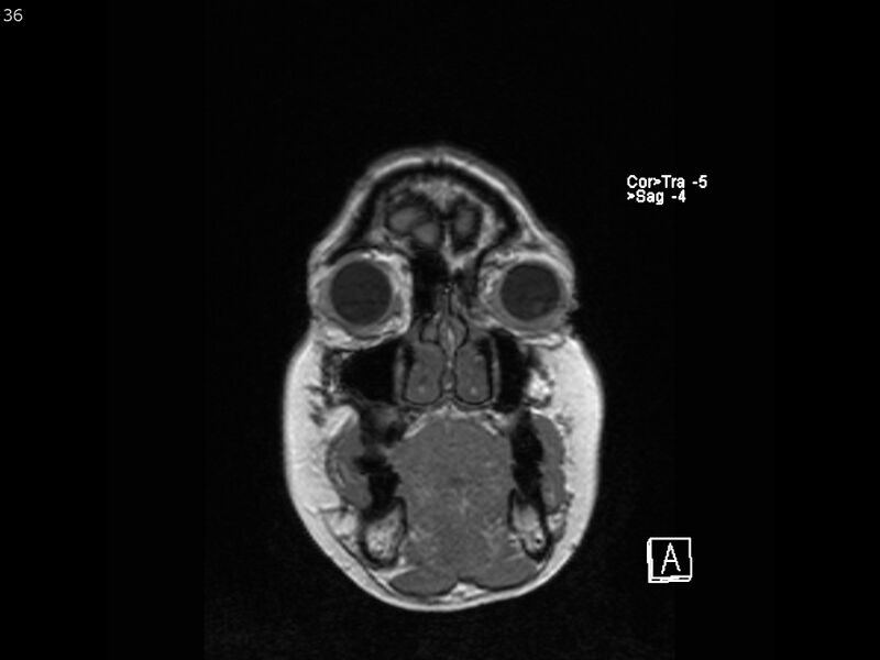 File:Atypical meningioma - intraosseous (Radiopaedia 64915-74572 Coronal T1 36).jpg